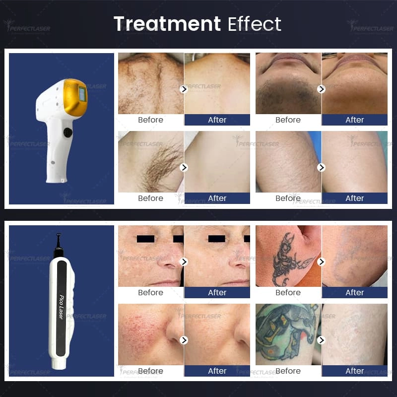 laser hair removal before and after