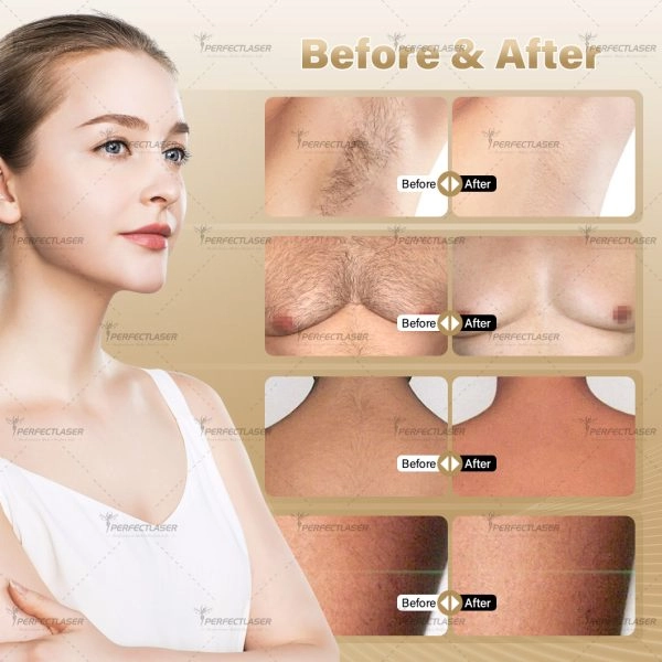 advanced diode hair removal technology before and after