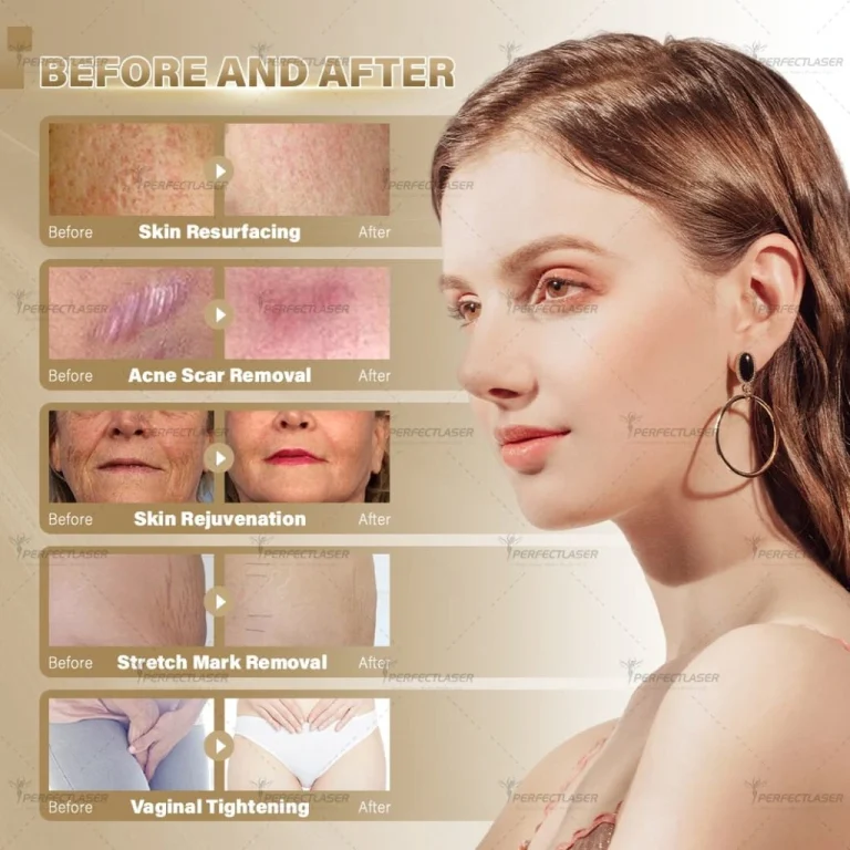 befor and after diode laser fiber