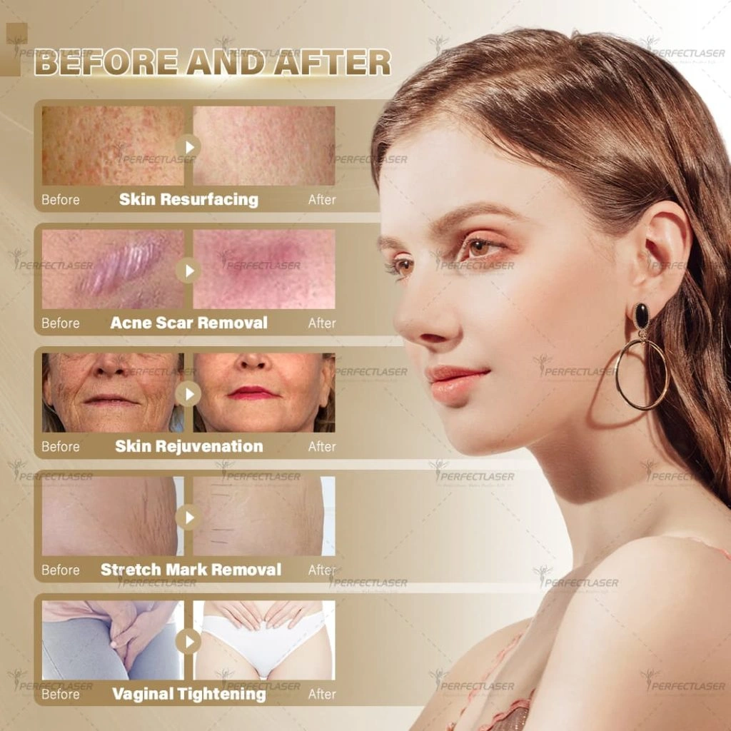 befor and after diode laser fiber