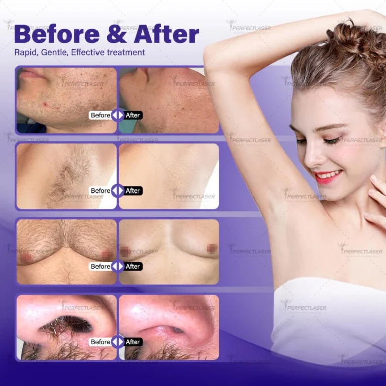 Diode Laser before and after