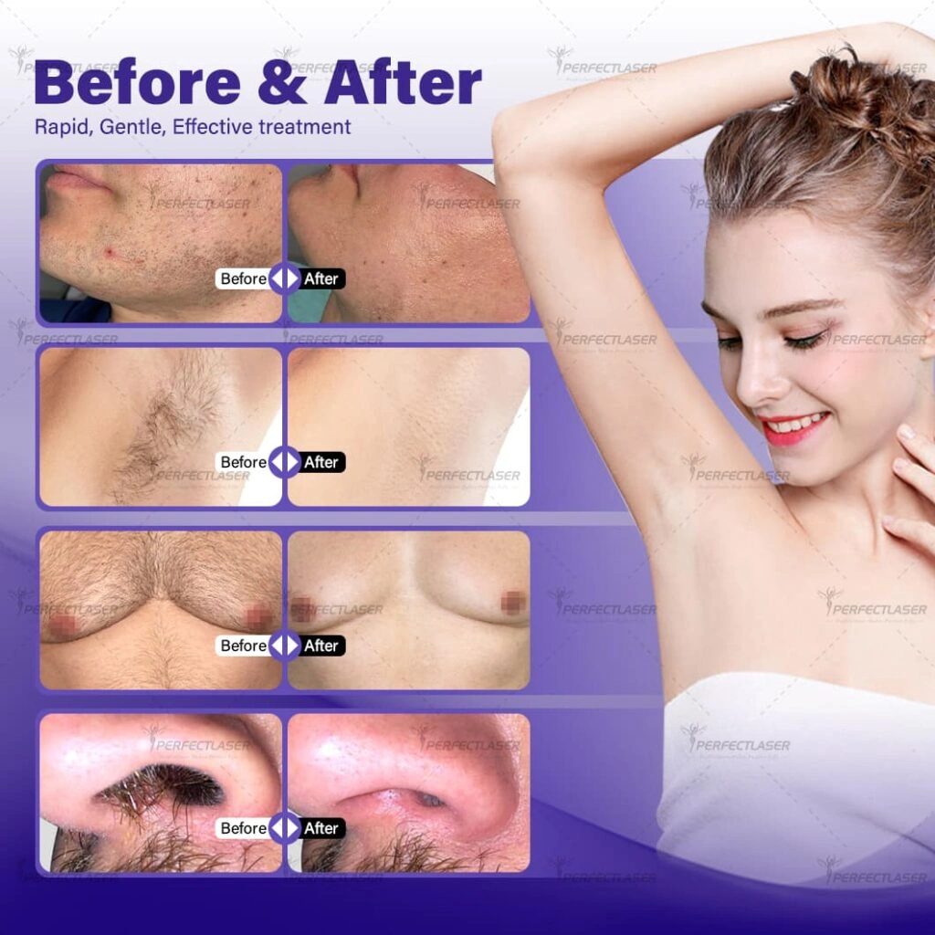 Diode Laser before and after