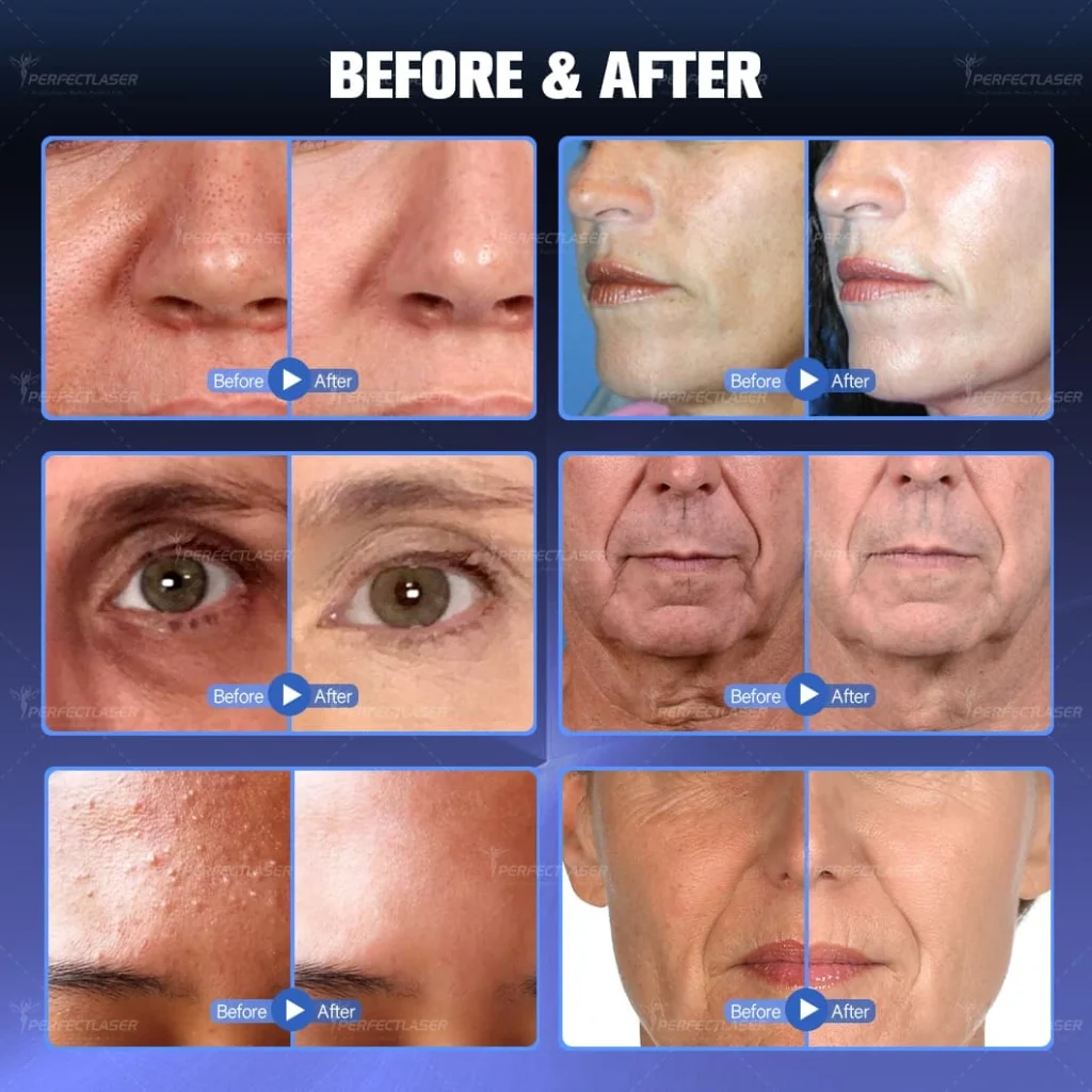 Hydra Dermabrasion before and after