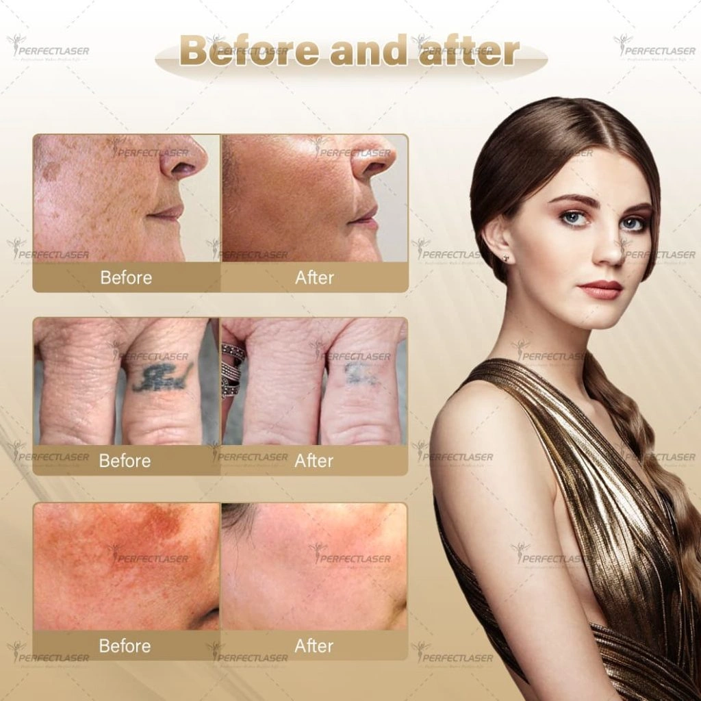 before and after Portable Nd Yag Laser Machine