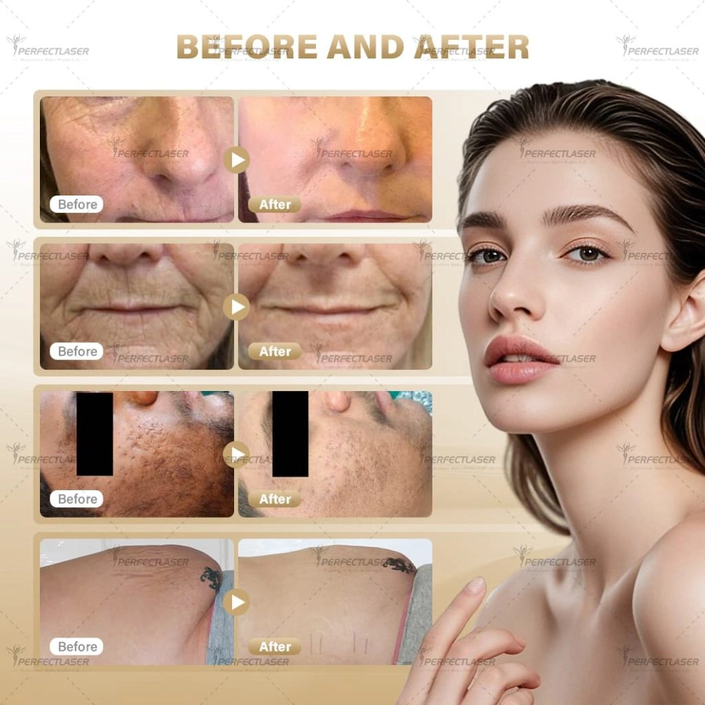 vaginal co2 laser machine2