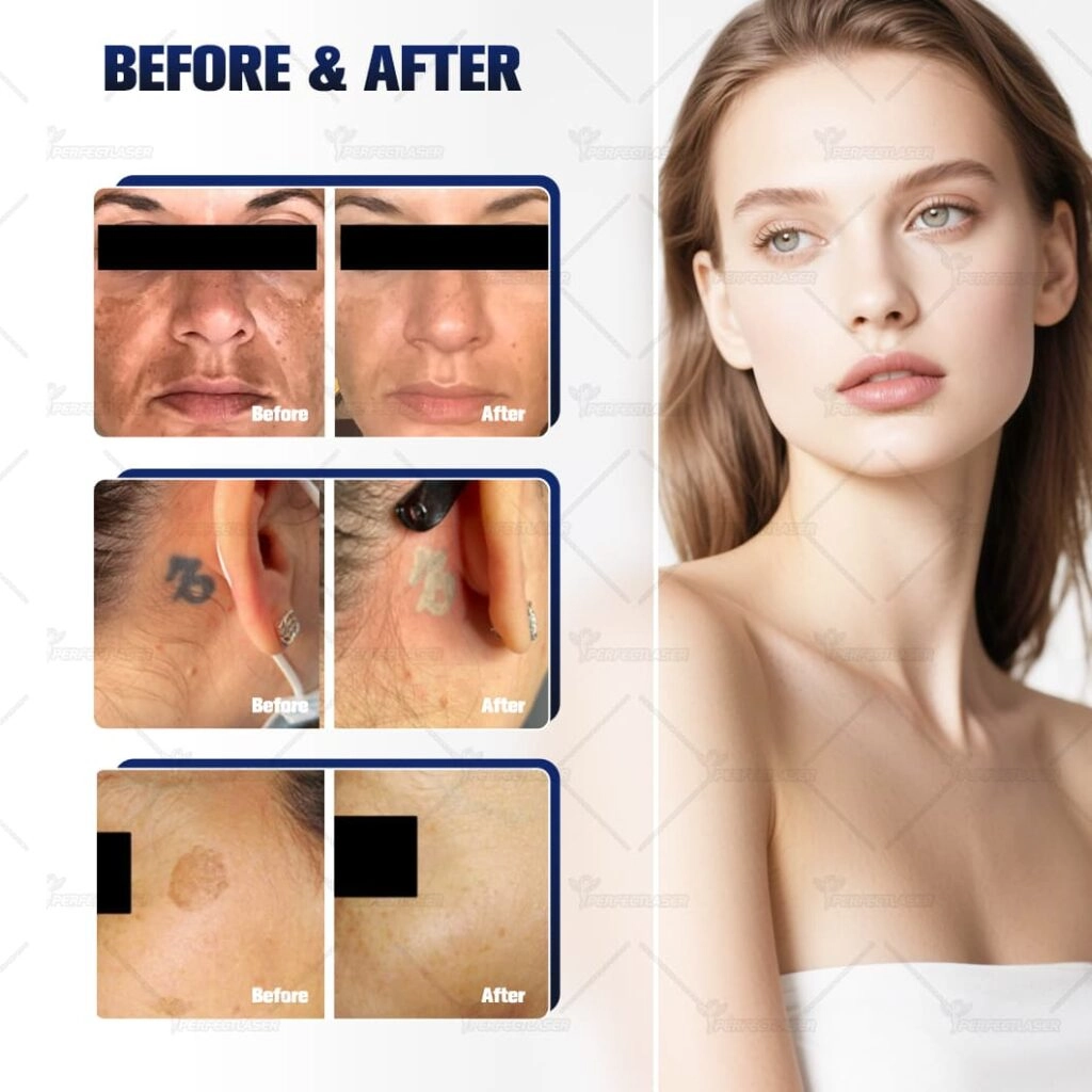 Picosecond laser before and after
