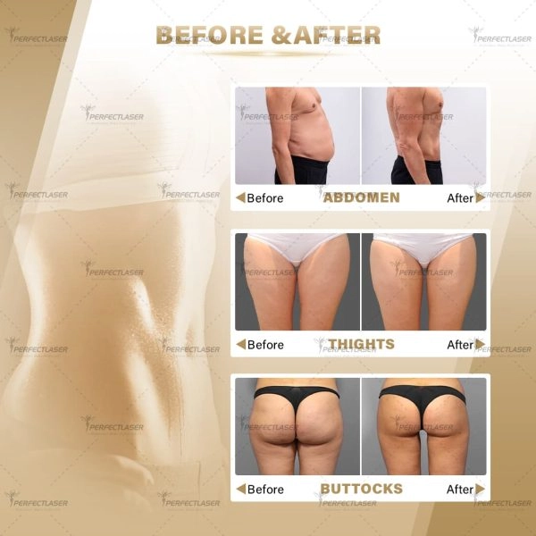 ems slimming machine before and after