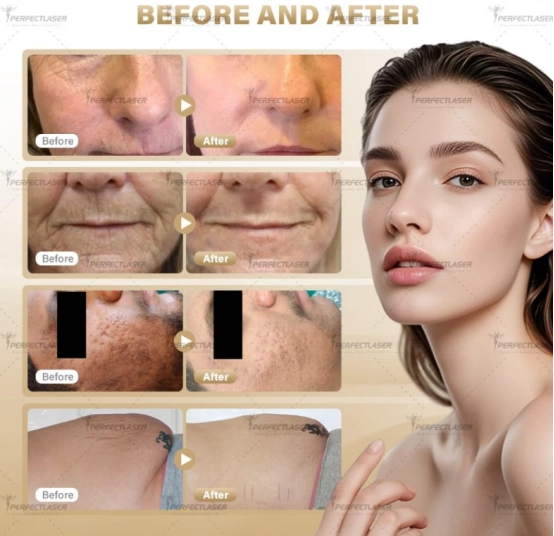 co2 fractional laser machine