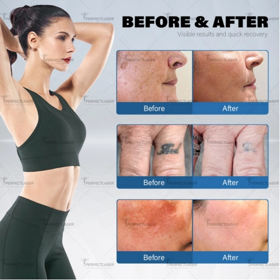 portable tattoo removal machine