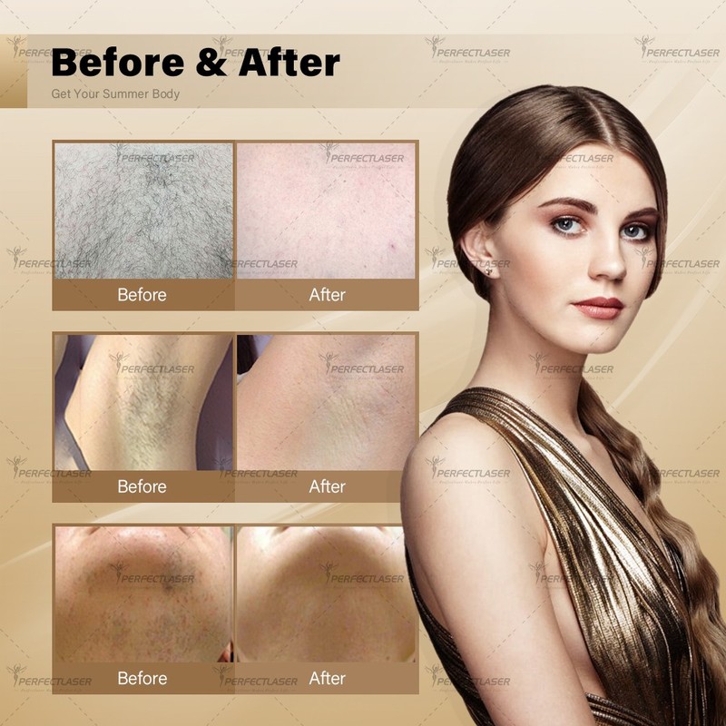 Alexandrite Laser Hair Removal Machine