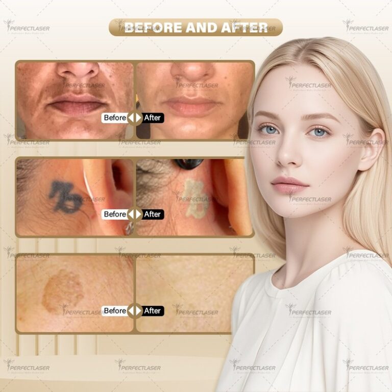 Machine d'enlèvement de tatouage laser Picosecond